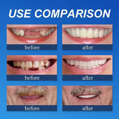 ⏰ Ends Today: 50% OFF!  KLENIMORE™ Daily Smile Confidence Set — Natural Look, Easy Everyday Wear