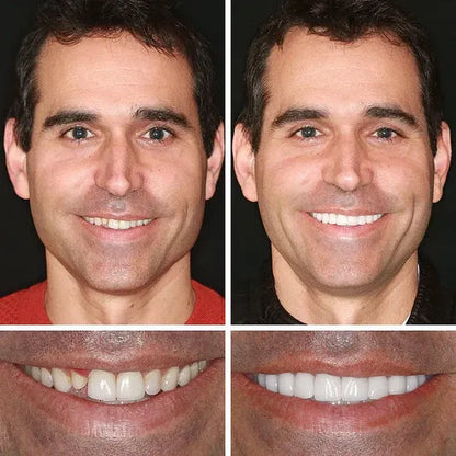 ⏰ Ends Today: 50% OFF!  KLENIMORE™ Daily Smile Confidence Set — Natural Look, Easy Everyday Wear