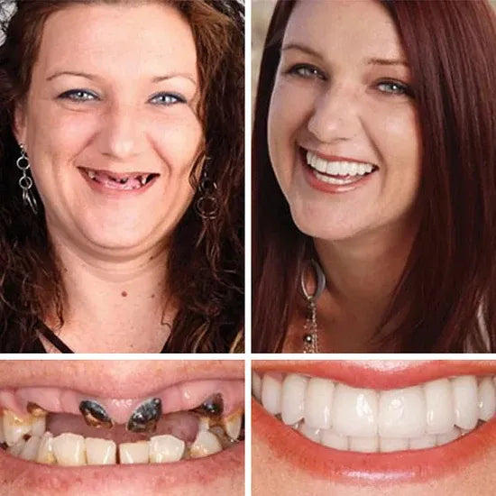 ⏰ Ends Today: 50% OFF! 🌎 KLENIMORE™ Daily Smile Confidence Set — Natural Look, Easy Everyday Wear