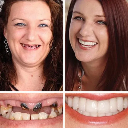 ⏰ Ends Today: 50% OFF! 🌎 KLENIMORE™ Daily Smile Confidence Set — Natural Look, Easy Everyday Wear