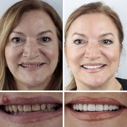 ⏰ Ends Today: 50% OFF! 🌎 KLENIMORE™ Daily Smile Confidence Set — Natural Look, Easy Everyday Wear